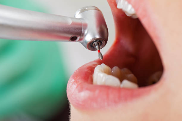 Best Urgent Tooth Repair  in Albion, NE